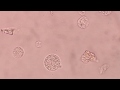 oval fat bodies and fat droplets in urine