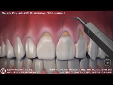 Animation of Pinhole® Surgical Technique