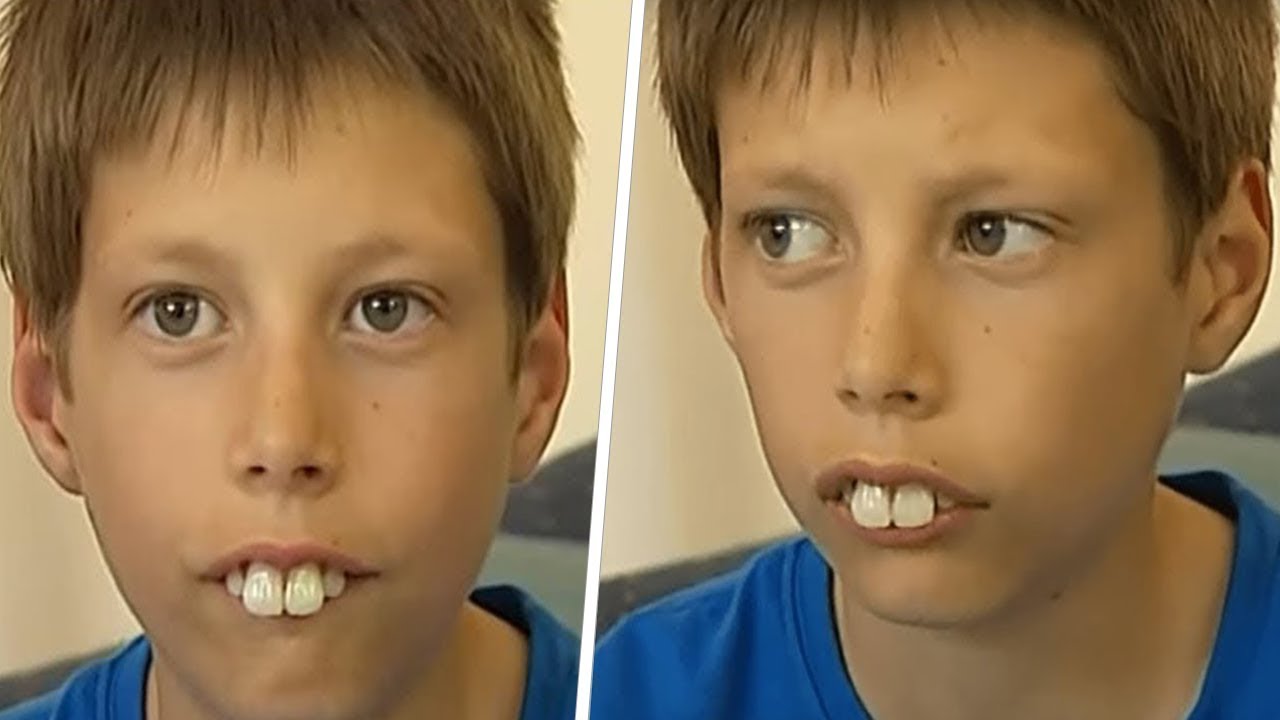 В ШКОЛЕ НАД НИМ ИЗДЕВАЛИСЬ ИЗ-ЗА ЕГО ЗУБОВ. НО СПУСТЯ НЕСКОЛЬКО ЛЕТ ОН УДИВИЛ ВСЕХ!