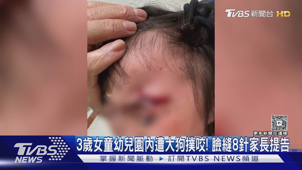 3歲女童幼兒園內遭大狗撲咬「眉上撕裂」縫8針　家長怒告園方