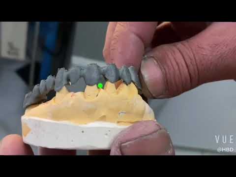 Metal 3D Printing in Dental - One Stop dental solution - SLM/DMLS/PBF HBD Metal 3D Printer