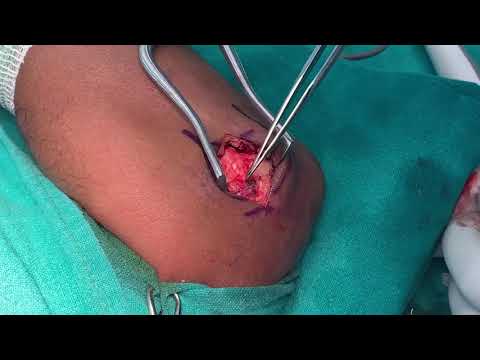 Topaz Coblation For Tennis Elbow And Plantar Fasciitis