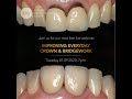 SPG Webinar Improving Everyday Crown Bridge
