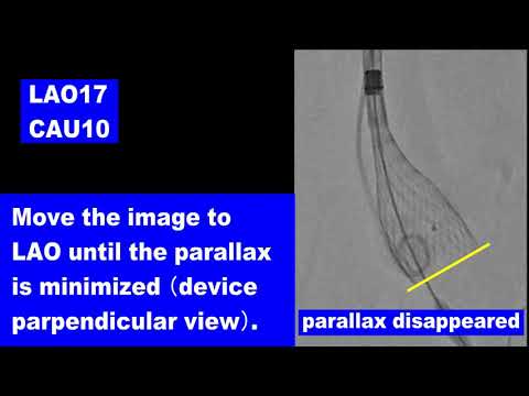 Cusp Overlap Technique with HEARTROID TAVI model