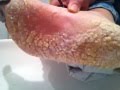 Dry cracked foot skin 