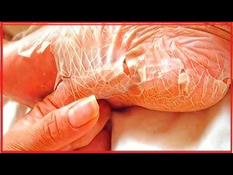 El hongo candida en las uñas Como curar el hongo sobre las uñas a gv