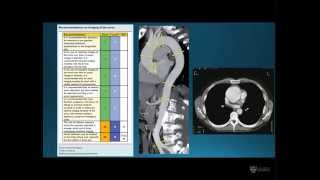 Dr Manu Mathur: Guidelines for aortic surgery