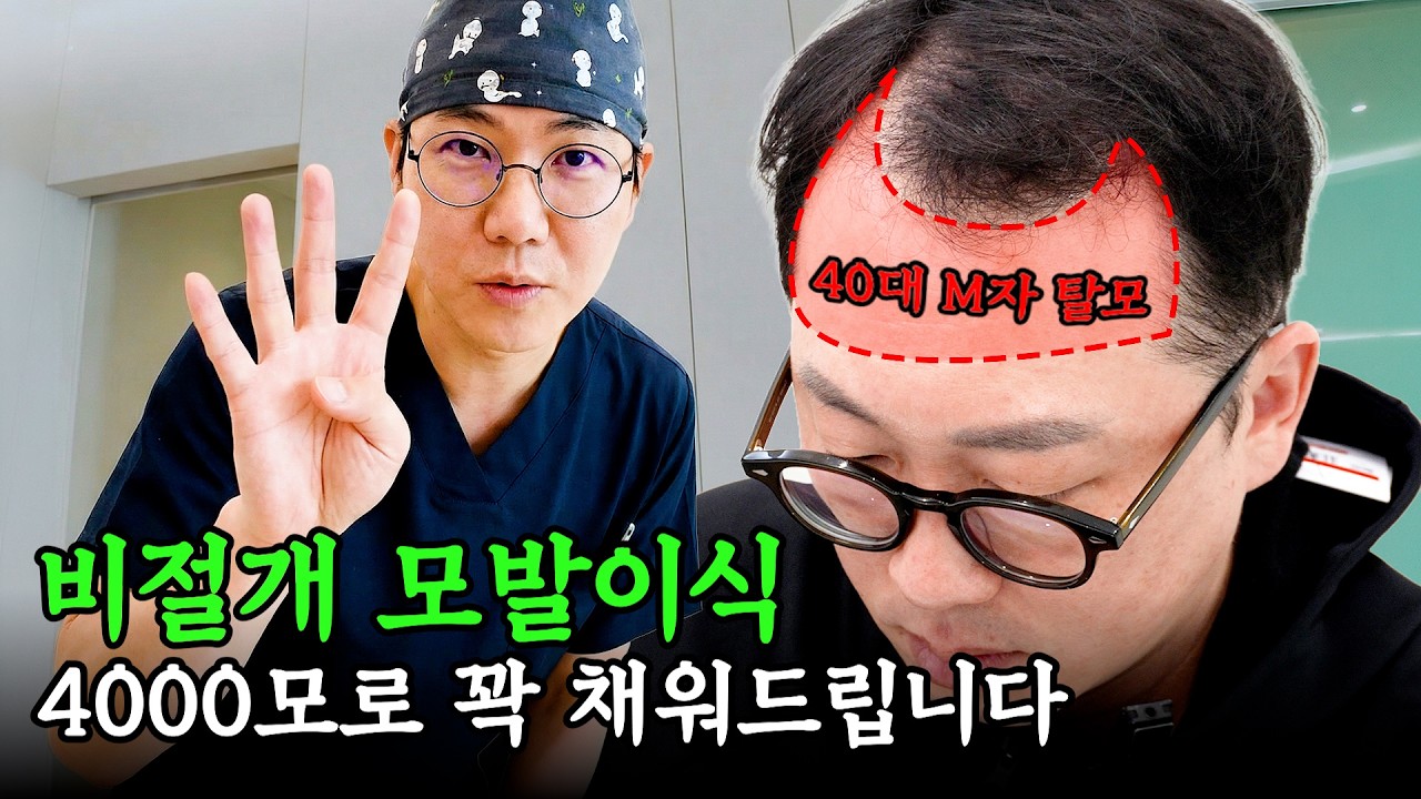 포기했던 40대 M자 탈모... 비절개 4000모로 되찾은 20대 헤어라인!