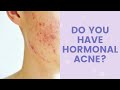 Do You Have Hormonal Acne? | FaceTory