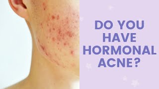 Do You Have Hormonal Acne? | FaceTory