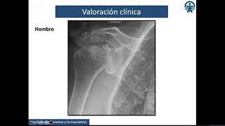 OSTEOARTROSIS - ARTRITIS - TENDINITIS