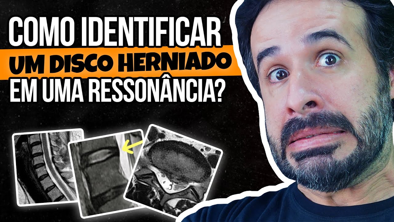 COMO IDENTIFICAR UM DISCO HERNIADO EM UMA RESSONÂNCIA.