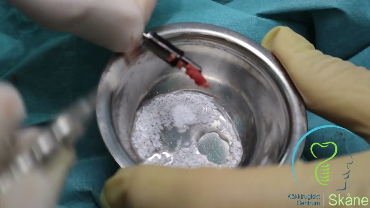 Extraction Sinuslyft and placment of Straumann 4,1 RN and 4,8 RN