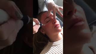 Microneedling