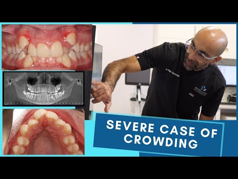 How To Fix Severe Dental Crowding?