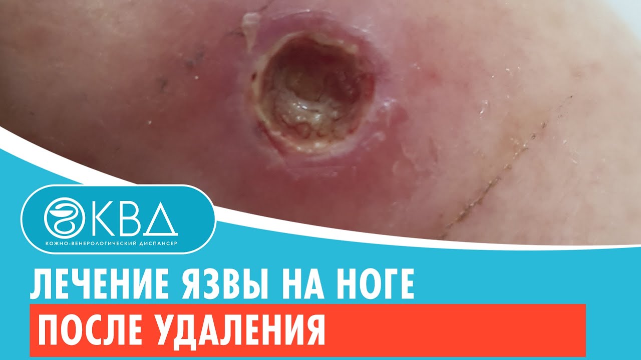 ✅ Лечение язвы на ноге после удаления. Клинический случай №522