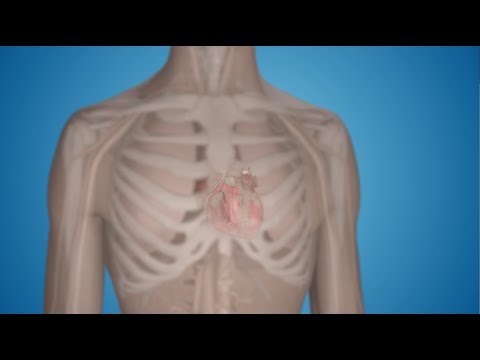 What Is a Pacemaker and How Does It Work?