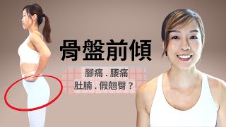 骨盤前傾矯正、成因、評估|伸展及強化肌肉運動|改善姿勢|物理治療師ERICA