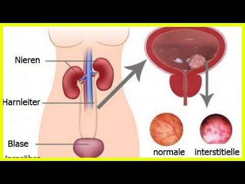 Weidenröschen und Prostatitis Prostata-spezifisches Antigen