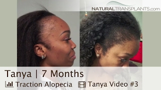 Best Female Hair Transplant Before and After | Hair Loss & Traction Alopecia in Women (Tanya)