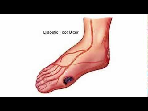 Diabetic Foot Care: Wounds and Ulcers - American Foot and Leg Specialists