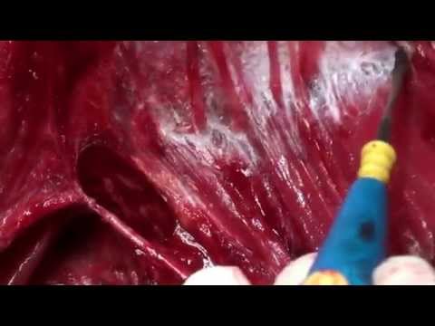 Neck Dissection For Head And Neck Squamous Cell Carcinoma