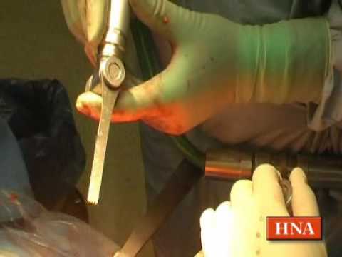 Knee Replacement Preis von Joint in St. Petersburg Es ist besser, aus den Fugen zu kaufen