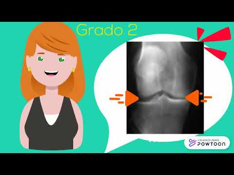 Osteoartrita articulațiilor de gradul I