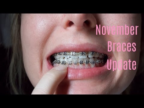 November Braces Update | Power Chain?