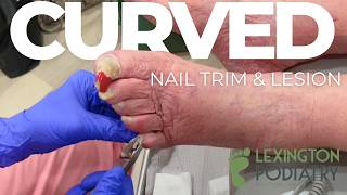 Curling Nail Clipping