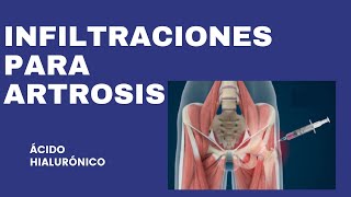 Tratamiento para la artrosis de cadera. Infiltraciones de ácido hialurónico