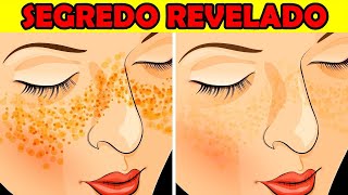 Como ACABAR Com as Espinhas e Cravos (de uma vez por todas!)