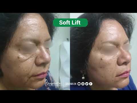Antes y Después – SoftLift