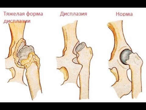 Лекарство для лечения боли в коленных суставах Хронический синовит коленного сустава видео
