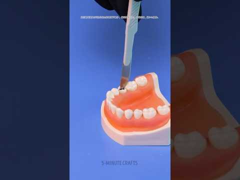 How tooth removal works at the dentist