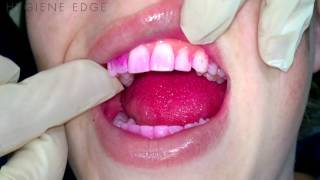 Disclosing Agents for Oral Hygiene Education