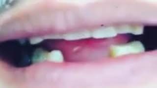 Snap on smile