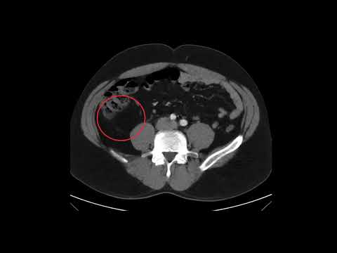 Massive Traumatic Retroperitoneal Hematoma, CT Annotated