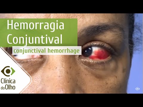 Conjunctival Hemorrhage | Eye Clinic