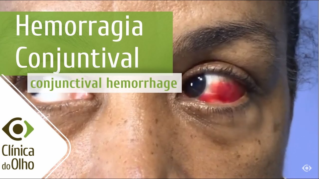 Sangue no olho pode ser Hemorragia Conjuntival | Clínica do Olho