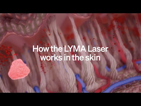 LYMA LASER EXCLUSIVE - How the LYMA Laser works in the skin.