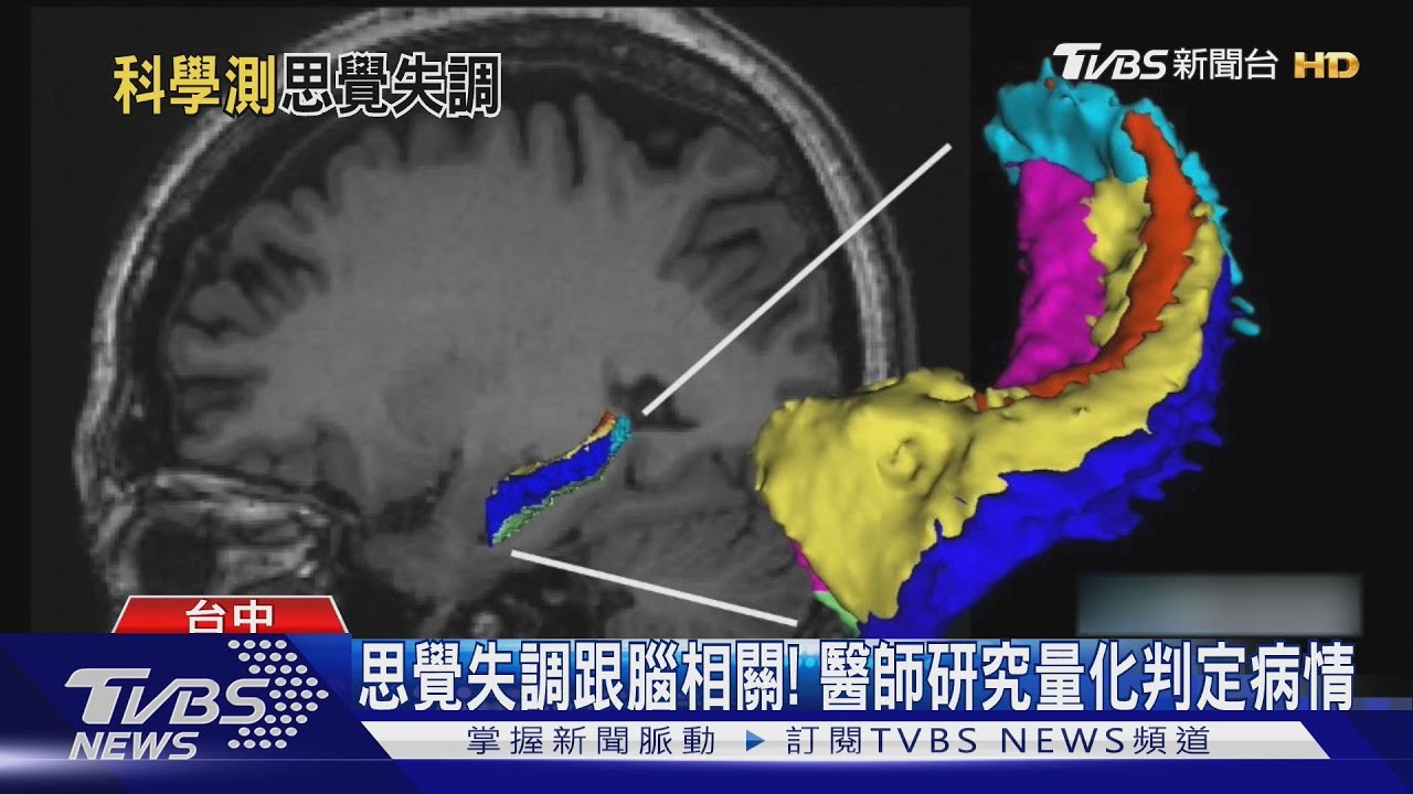 思覺失調跟腦相關! 醫師研究量化判定病情