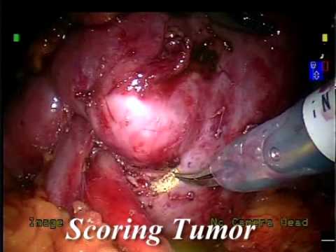 Renal Cancer - Partial Nephrectomy With Robot Assistance