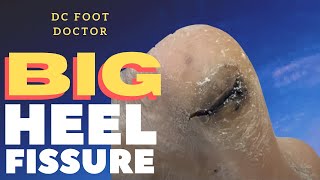 Big Heel Fissure: A Deep Crack in the Heel