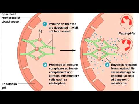 Type 3 Hypersensitivity (Type III)