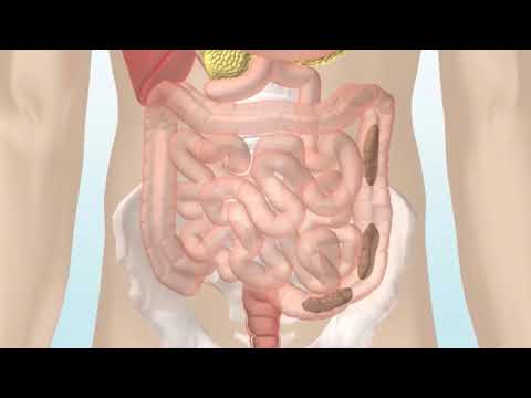 Was sind die verschiedenen Arten von Mundhöhlenkrebs