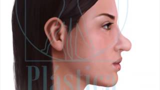 Rinoplastia - tipo de nariz redonda, ancha o bulbosa / Dr. Jorge Espinosa