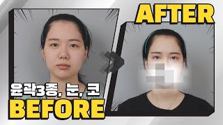 성형외과 직원인데요, 저도 결국 수술 받았습니다 (성형 리얼 후기)  / 윤곽 + 눈 + 코