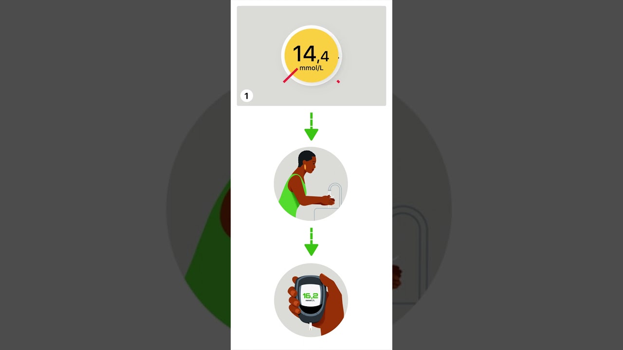IAV treatment decisions Dexcom ONE+ OUS HR MMOL