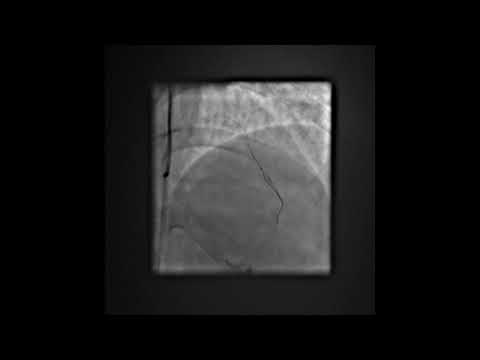 Antegrade Fenestration Reentry (AFR)